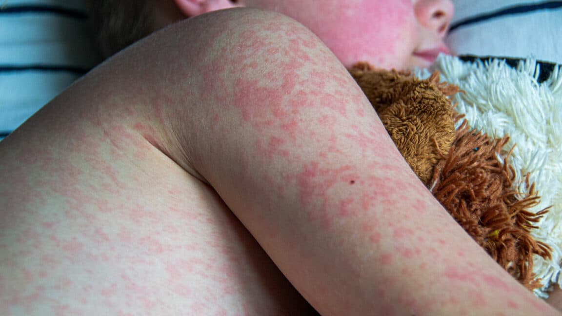 Texas measles outbreak highlights the significant risks of the virus.