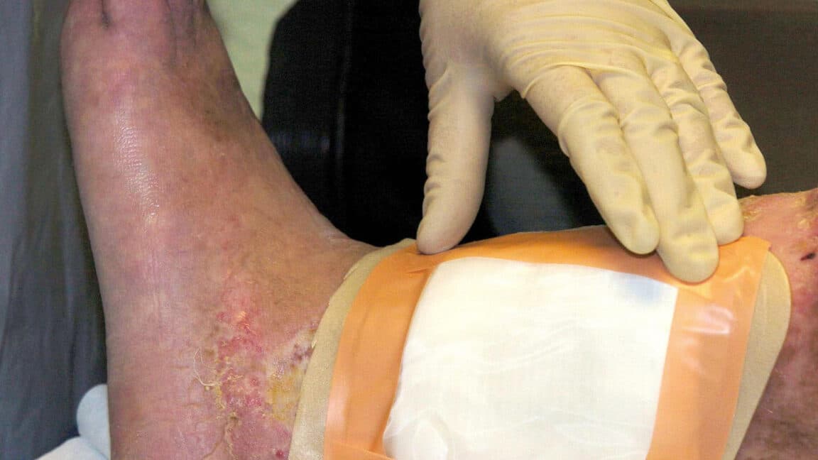 FDA approves new fly species for maggot therapy in wound care