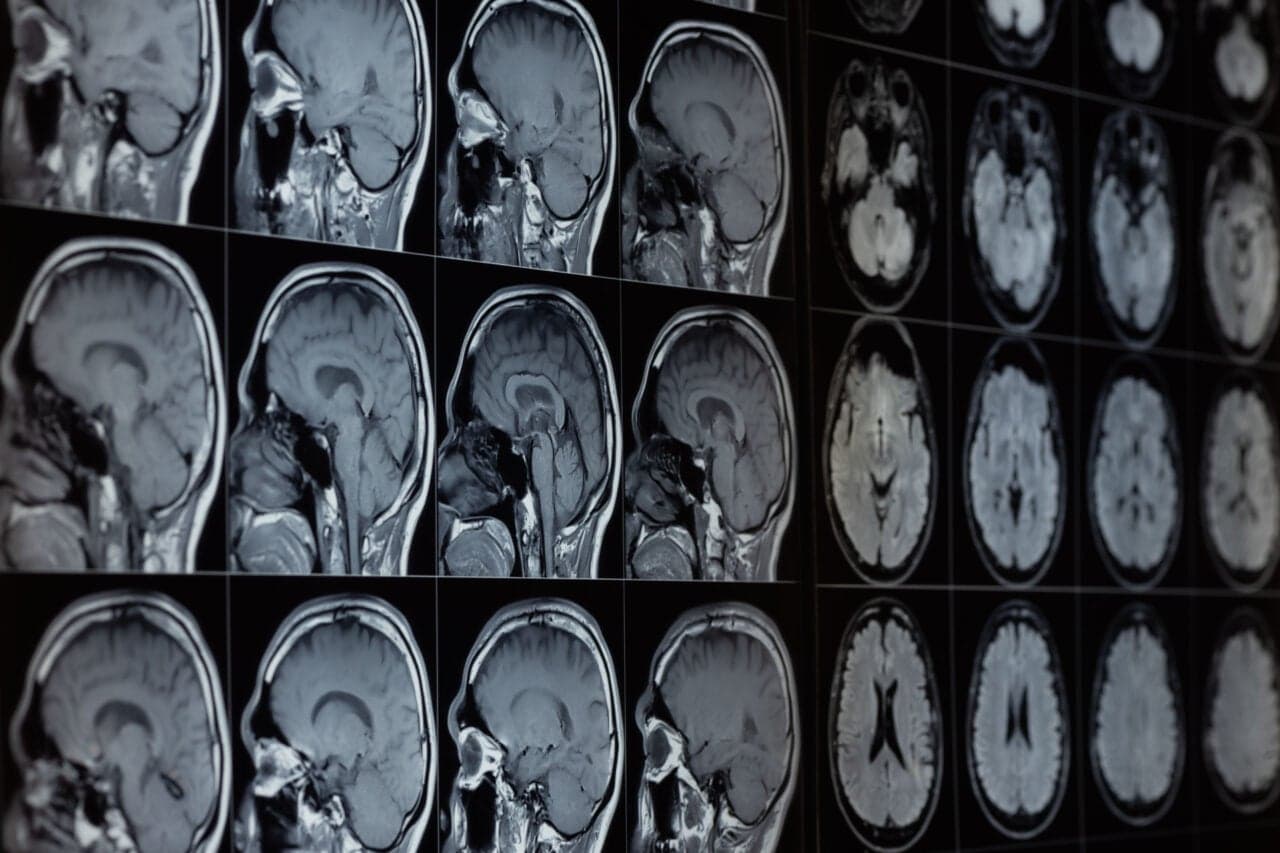 Scientists Are Trying to Freeze Strokes Before They Damage the Brain