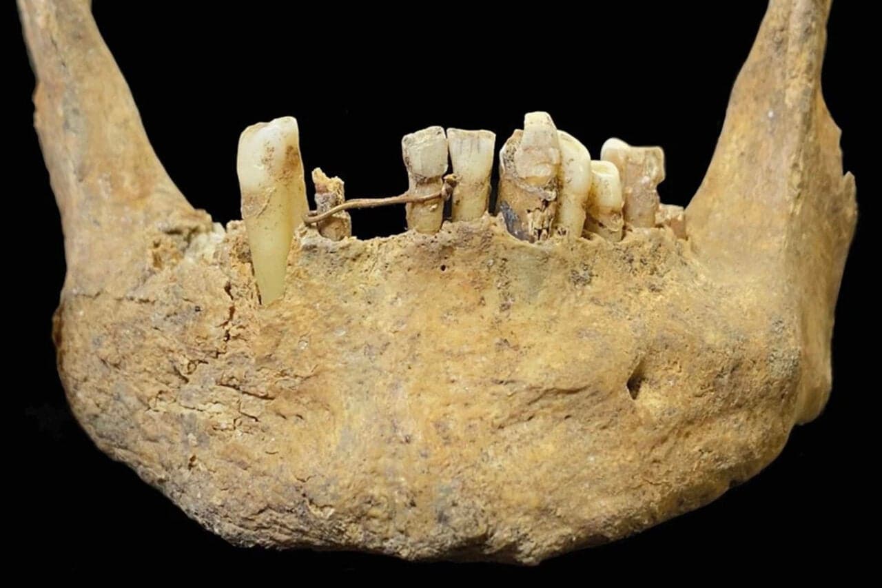Archaeologists Unearth ‘Advanced’ Gold Dental Bridge in Medieval Scottish Grave