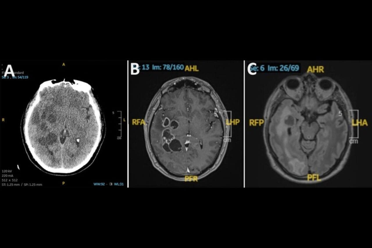 Man’s Suspected Brain Cancer Turns Out to Be Something Much Creepier